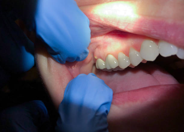 Best Chipped Tooth Repair Near Me  in Paducah, TX